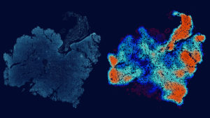 Glioblastoma tumor slice and corresponding density map